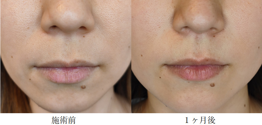 代で既にほうれい線が目立っている人の原因と対策方法