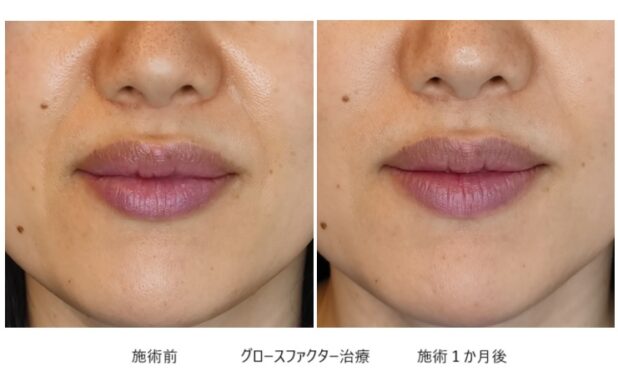 40代女性 症例1のほうれい線治療写真