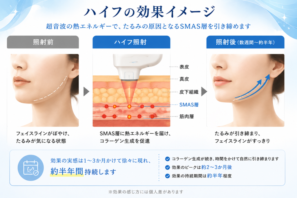 ハイフ（HIFU）だけでほうれい線は改善する？効果・限界・向いている人