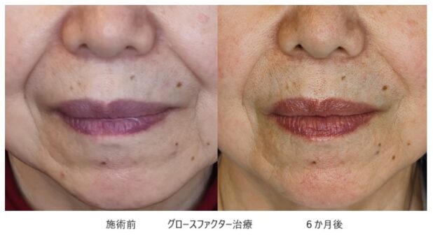 60代女性 症例5のほうれい線治療写真
