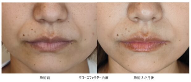 30代女性 症例3のほうれい線治療写真