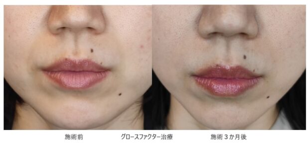 30代女性 症例2のほうれい線治療写真
