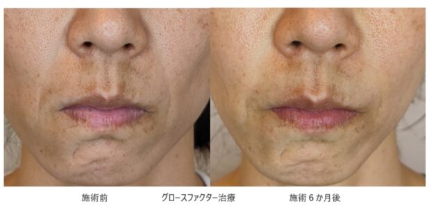 40代女性 症例7のほうれい線治療写真