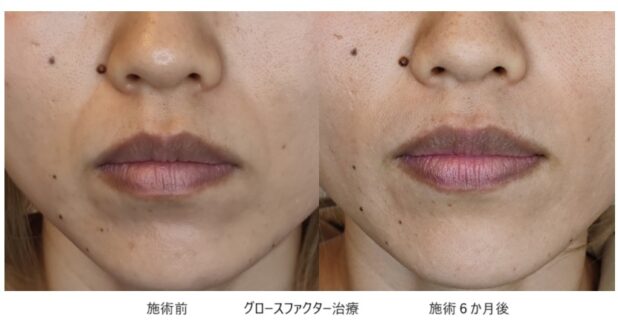 30代女性 症例1のほうれい線治療写真