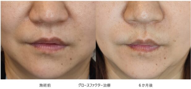 40代女性 症例3のほうれい線治療写真