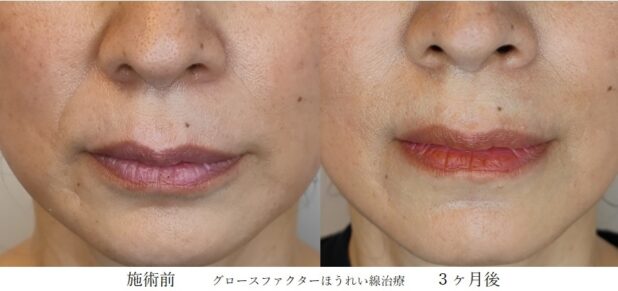 50代女性 症例8のほうれい線治療写真
