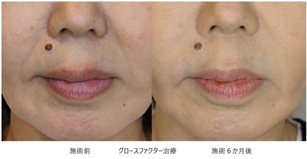 50代女性 症例7のほうれい線治療写真