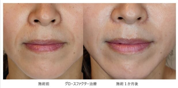 40代女性 症例4のほうれい線治療写真