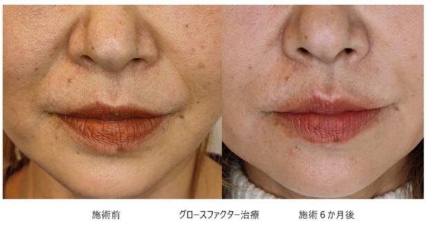 50代女性 症例3のほうれい線治療写真
