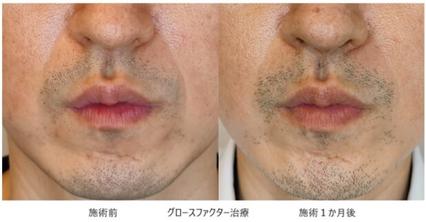 30代男性 症例2のほうれい線治療写真