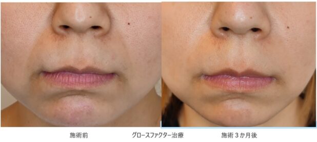 30代女性 症例5のほうれい線治療写真