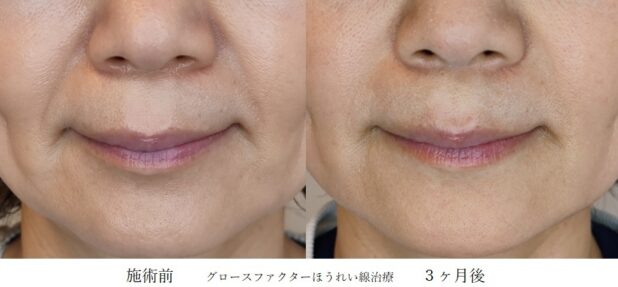 50代女性 症例1のほうれい線治療写真