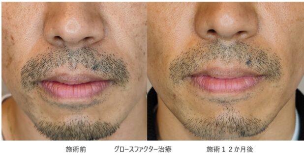 40代男性 症例1のほうれい線治療写真