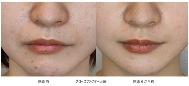 30代女性 症例8のほうれい線治療写真