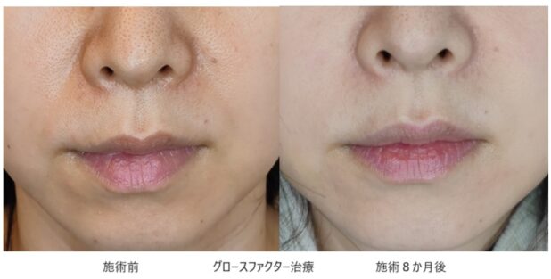 30代女性 症例4のほうれい線治療写真