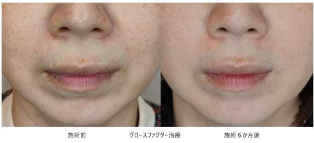 40代女性 症例10のほうれい線治療写真