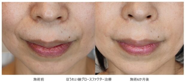 50代女性 症例4のほうれい線治療写真