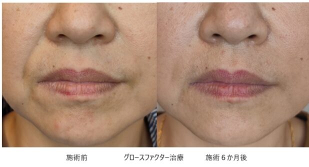 50代女性 症例6のほうれい線治療写真