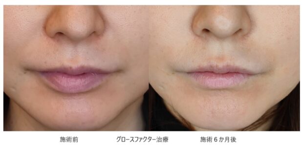 30代女性 症例6のほうれい線治療写真