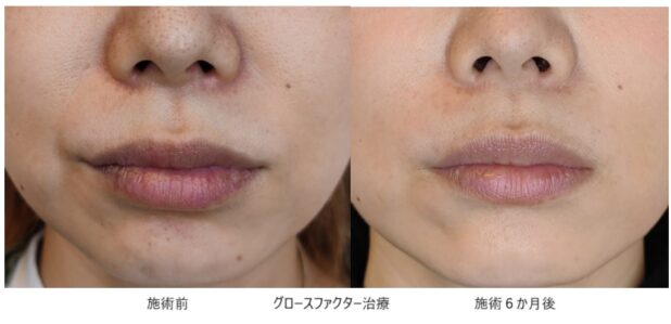 40代女性 症例5のほうれい線治療写真