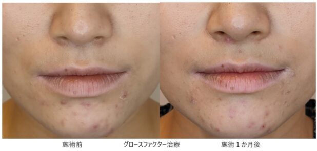 30代女性 症例7のほうれい線治療写真