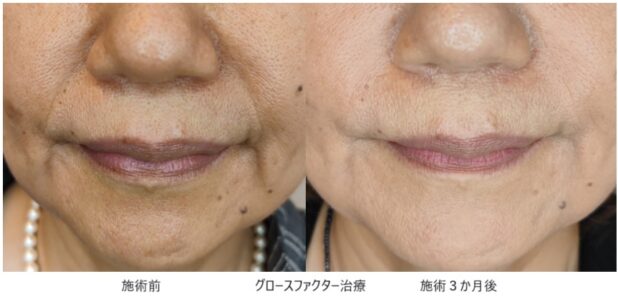 60代女性 症例2のほうれい線治療写真