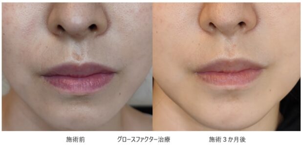20代女性 症例4のほうれい線治療写真