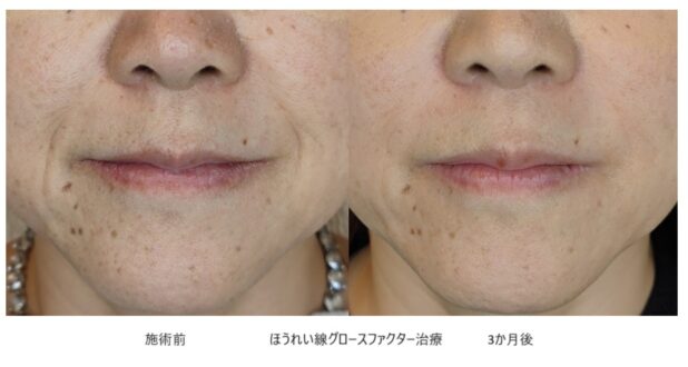 50代女性 症例2のほうれい線治療写真