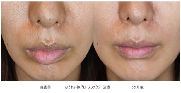 30代女性 症例11のほうれい線治療写真