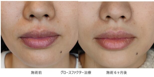 40代女性 症例12のほうれい線治療写真