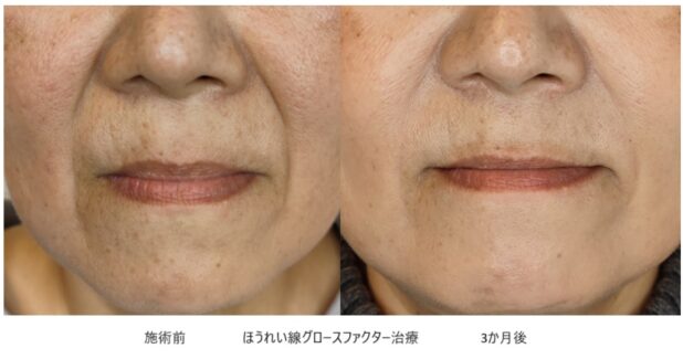 50代女性 症例14のほうれい線治療写真