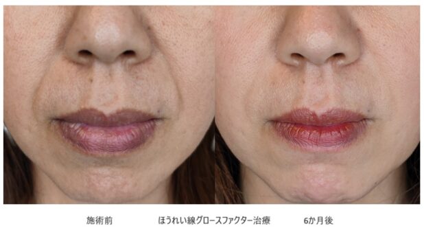 50代女性 症例12のほうれい線治療写真