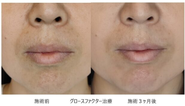 40代女性 症例9のほうれい線治療写真