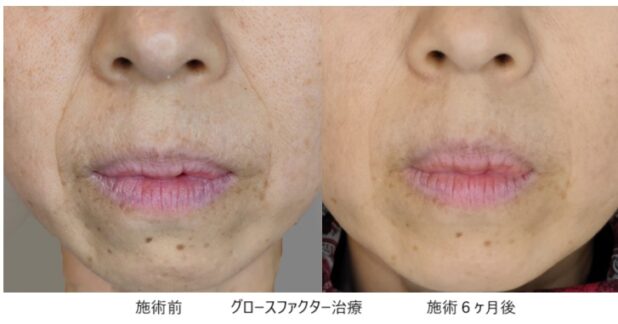 40代女性 症例14のほうれい線治療写真