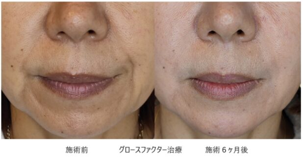 60代女性 症例3のほうれい線治療写真