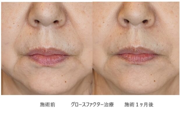 60代女性 症例4のほうれい線治療写真