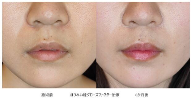 20代女性 症例6のほうれい線治療写真