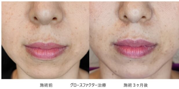 30代女性 症例9のほうれい線治療写真