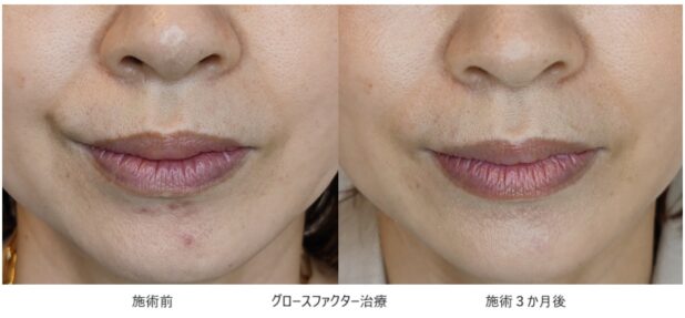 40代女性 症例11のほうれい線治療写真