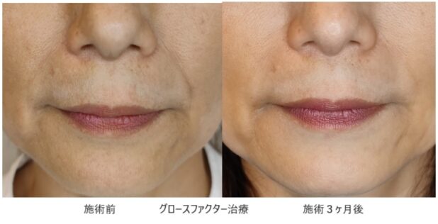 50代女性 症例13のほうれい線治療写真