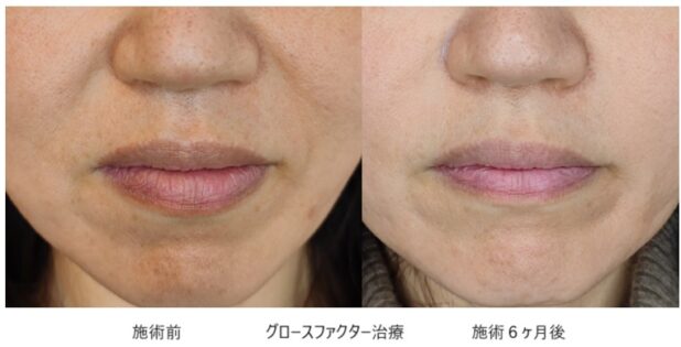 50代女性 症例11のほうれい線治療写真