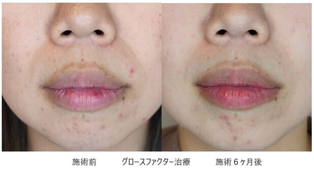 30代女性 症例10のほうれい線治療写真