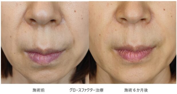 50代女性 症例9のほうれい線治療写真