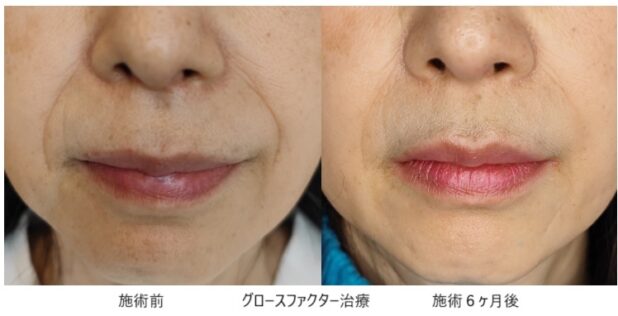 50代女性 症例10のほうれい線治療写真