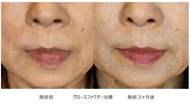 50代女性 症例5のほうれい線治療写真