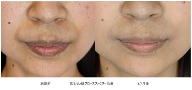 30代女性 症例13のほうれい線治療写真