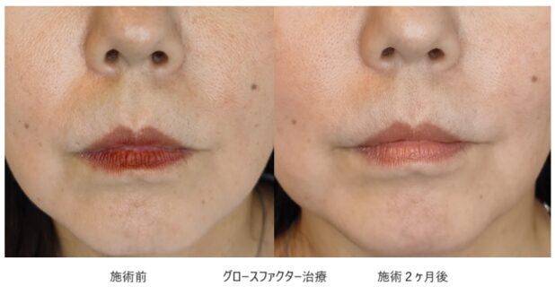 40代女性 症例15のほうれい線治療写真