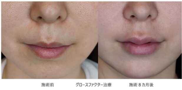 30代女性 症例12のほうれい線治療写真