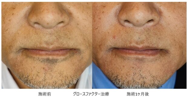 50代男性 症例2のほうれい線治療写真