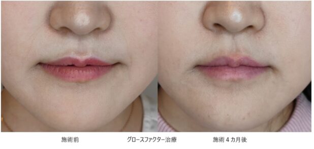 20代女性 症例1のほうれい線治療写真